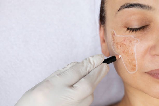 PIGMENTATION